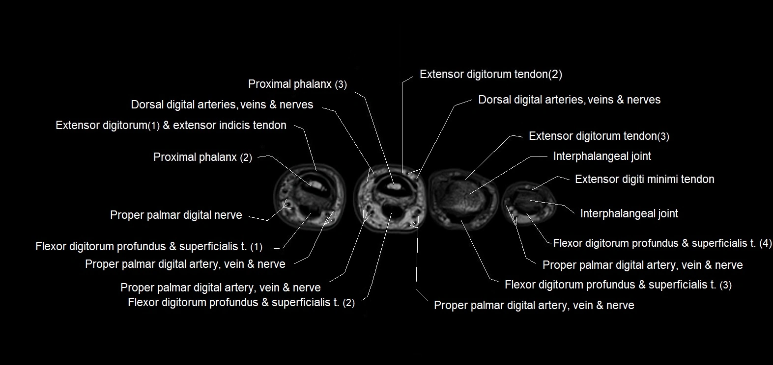 MRI 3T  hand axial labelled cross sectional anatomy imagemy  30.webp